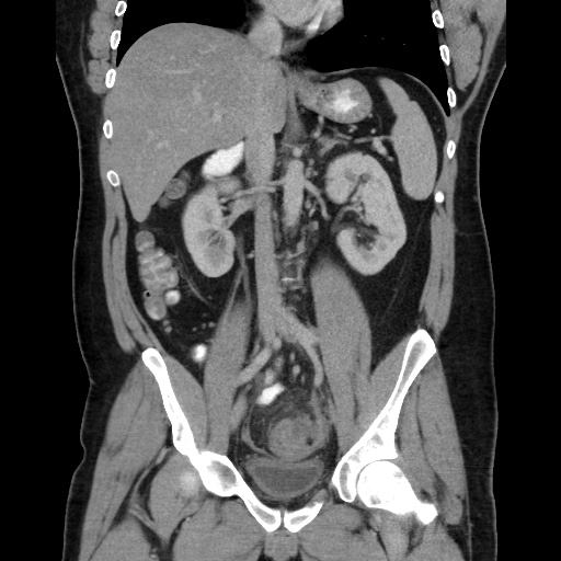Acute diverticulitis with localized perforation (Radiopaedia 41296-44113 Coronal C+ portal venous phase 35).jpg