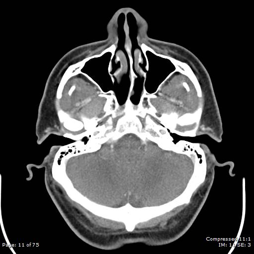 Acute epiglottitis (Radiopaedia 54375-60590 Axial C+ arterial phase 11).jpg