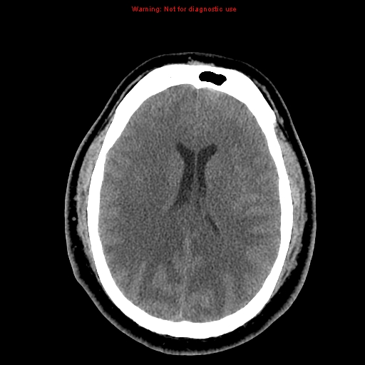 File:Acute hemorrhagic leukoencephalitis (Radiopaedia 14076-13920 Axial non-contrast 30).jpg