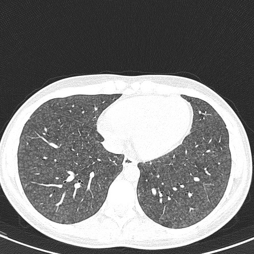 File:Acute hypersensitivity pneumonitis (Radiopaedia 85293-100870 Axial lung window 87).jpg