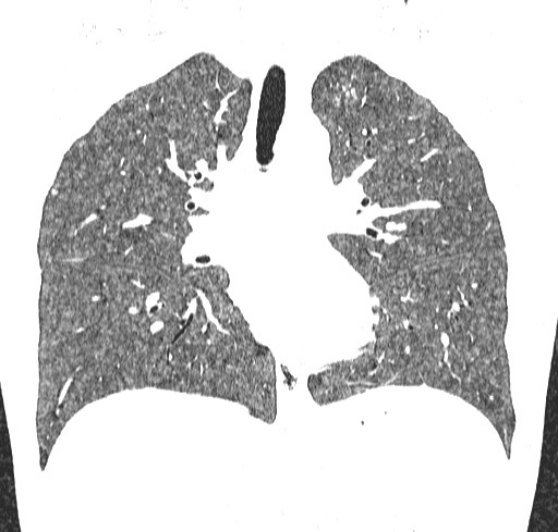 Acute hypersensitivity pneumonitis (Radiopaedia 85293-100870 Coronal lung window 65).jpg