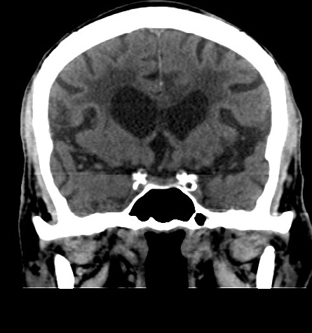Acute left anterior cerebral artery territory infarction (Radiopaedia 51785-57578 Coronal non-contrast 24).jpg