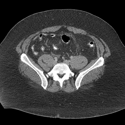 Acute mesenteric venous ischemia (Radiopaedia 46041-50383 Axial C+ portal venous phase 99).jpg