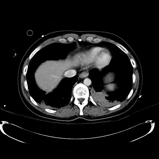 Acute myocardial infarction in CT (Radiopaedia 39947-42415 Axial C+ portal venous phase 15).jpg