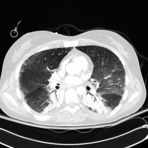 Acute myocardial infarction in CT (Radiopaedia 39947-42415 Axial lung window 65).jpg