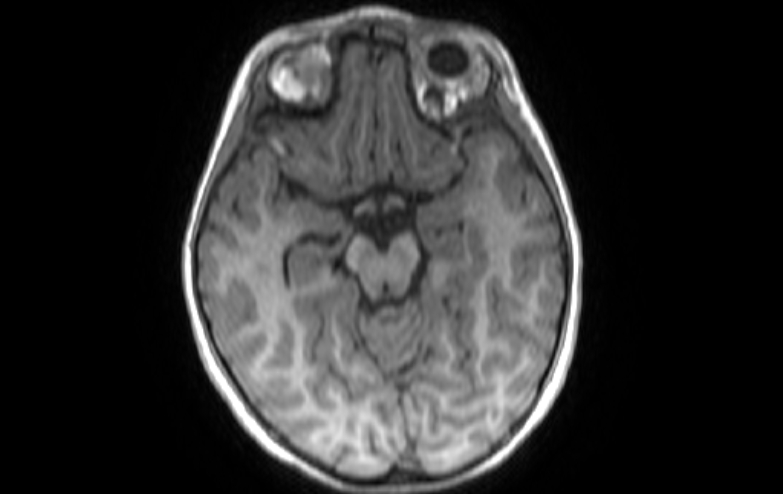 File:Acute necrotizing encephalitis of childhood (Radiopaedia 67356-76737 Axial T1 59).jpg