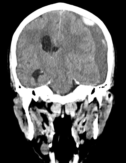 Acute on chronic subdural hematoma (Radiopaedia 74814-85823 Coronal non-contrast 35).jpg
