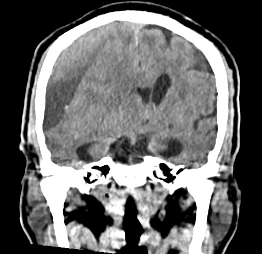 Acute on chronic subdural hematoma (Radiopaedia 78346-90966 Coronal non-contrast 34).jpg