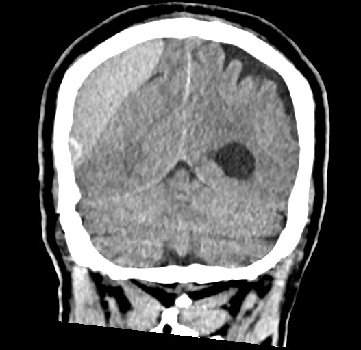 Acute on chronic subdural hematoma (Radiopaedia 78346-90966 Coronal non-contrast 51).jpg