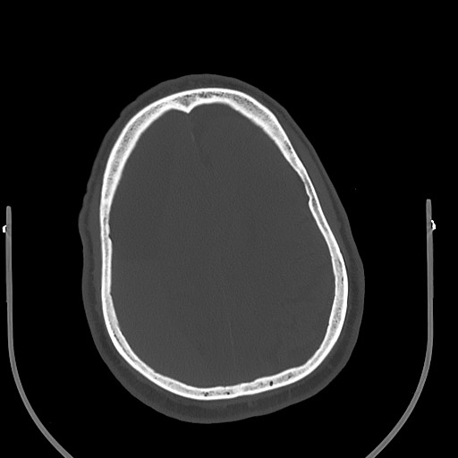 Acute on chronic subdural hematoma (Radiopaedia 78346-90966 D 62).jpg