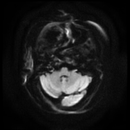 Acute otitis externa (Radiopaedia 57296-64236 Axial DWI 6).jpg
