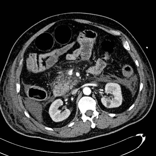File:Acute pancreatic necrosis (Radiopaedia 13560-13486 Axial C+ portal venous phase 64).jpg