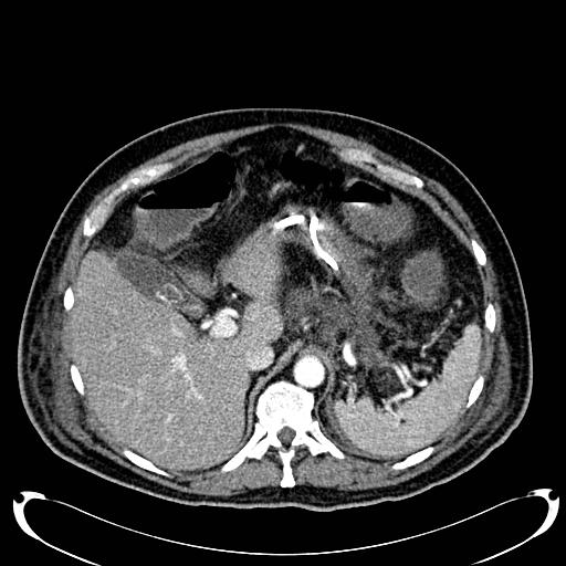 Acute pancreatic necrosis (Radiopaedia 13560-18500 Axial C+ portal venous phase 40).jpg