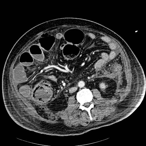 Acute pancreatic necrosis (Radiopaedia 13560-18502 Axial C+ portal venous phase 58).jpg