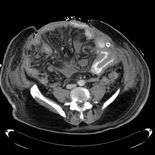 Acute pancreatic necrosis (Radiopaedia 13560-18503 Axial C+ portal venous phase 52).jpg