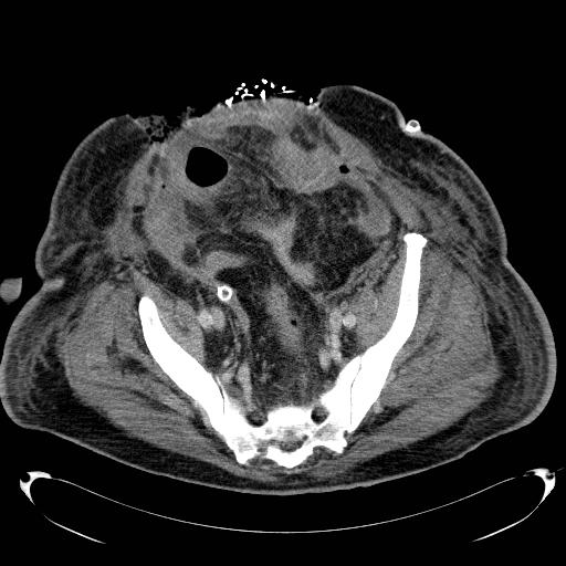 Acute pancreatic necrosis (Radiopaedia 13560-18503 Axial C+ portal venous phase 67).jpg