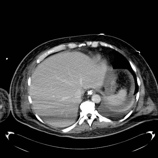 Acute pancreatic necrosis (Radiopaedia 13560-18503 Axial C+ portal venous phase 8).jpg