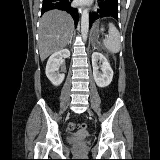 File:Acute pancreatitis (Radiopaedia 20829-20744 Coronal C+ portal venous phase 36).jpg