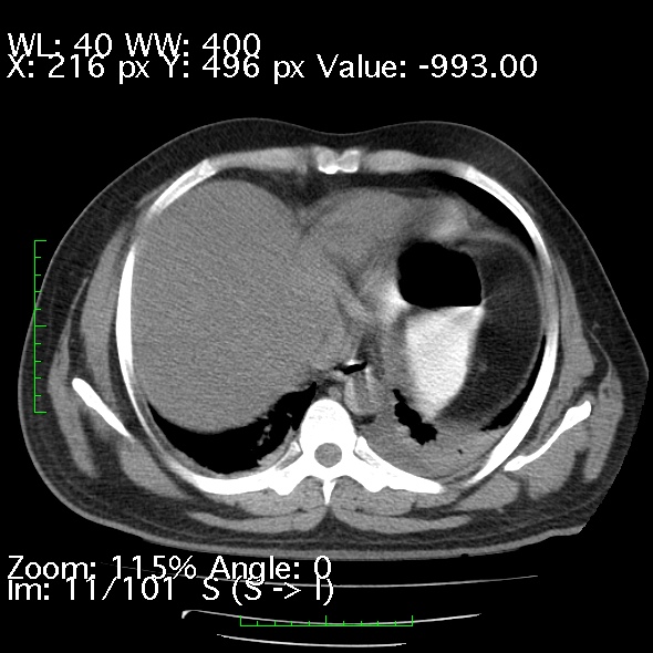 Acute pancreatitis (Radiopaedia 34043-35276 Axial non-contrast 11).jpg