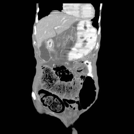 File:Acute pancreatitis (Radiopaedia 50213-55558 Coronal C+ portal venous phase 4).jpg