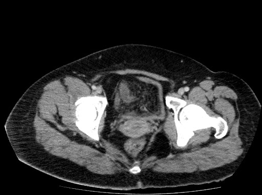 Acute pancreatitis (Radiopaedia 69236-79012 Axial C+ portal venous phase 85).jpg