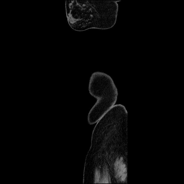 Acute pancreatitis (Radiopaedia 69236-79012 Sagittal C+ portal venous phase 7).jpg