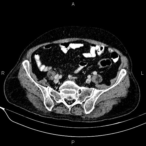 Acute pancreatitis (Radiopaedia 85146-100701 Axial C+ portal venous phase 49).jpg