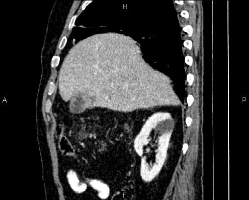 Acute pancreatitis (Radiopaedia 85146-100701 Sagittal C+ portal venous phase 23).jpg