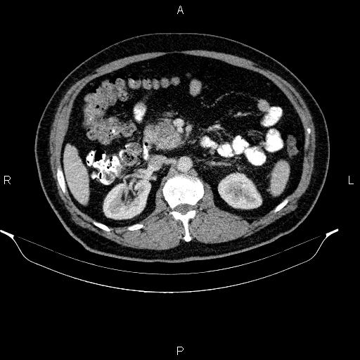 Acute pancreatitis (Radiopaedia 85390-101010 Axial C+ portal venous phase 42).jpg