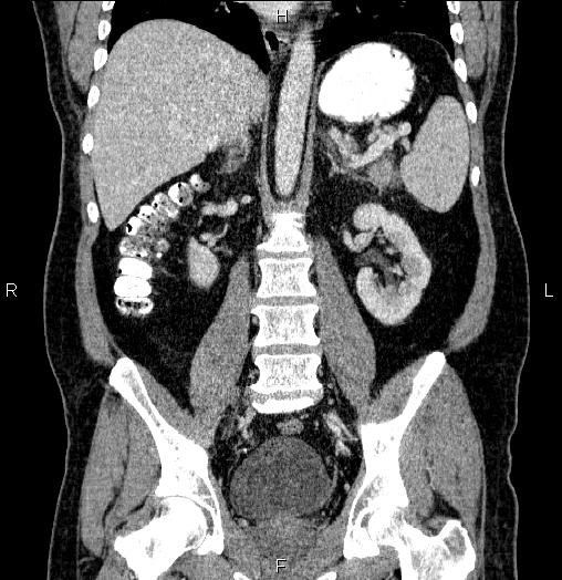 Acute pancreatitis (Radiopaedia 85390-101010 Coronal C+ portal venous phase 44).jpg
