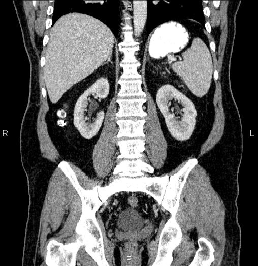 Acute pancreatitis (Radiopaedia 85390-101010 Coronal C+ portal venous phase 49).jpg