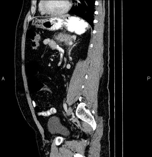 Acute pancreatitis (Radiopaedia 85390-101010 Sagittal C+ portal venous phase 66).jpg