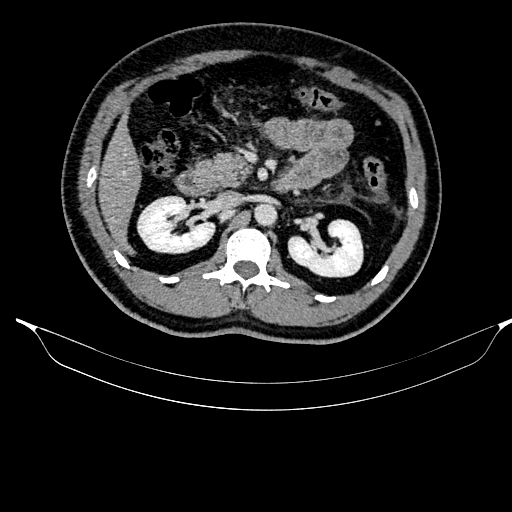 Acute pancreatitis (Radiopaedia 87428-103757 Axial C+ portal venous phase 41).jpg