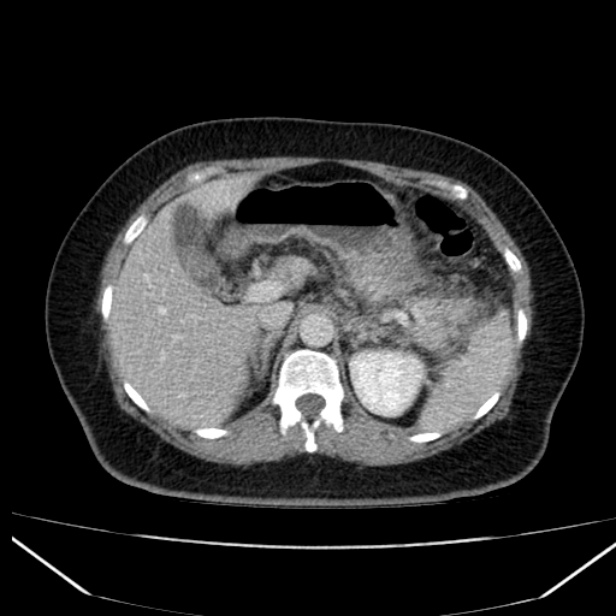 Acute pancreatitis - Balthazar C (Radiopaedia 26569-26714 Axial C+ portal venous phase 33).jpg