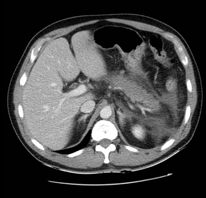 Acute pancreatitis - Balthazar E (Radiopaedia 23080-23110 Axial C+ portal venous phase 18).jpg