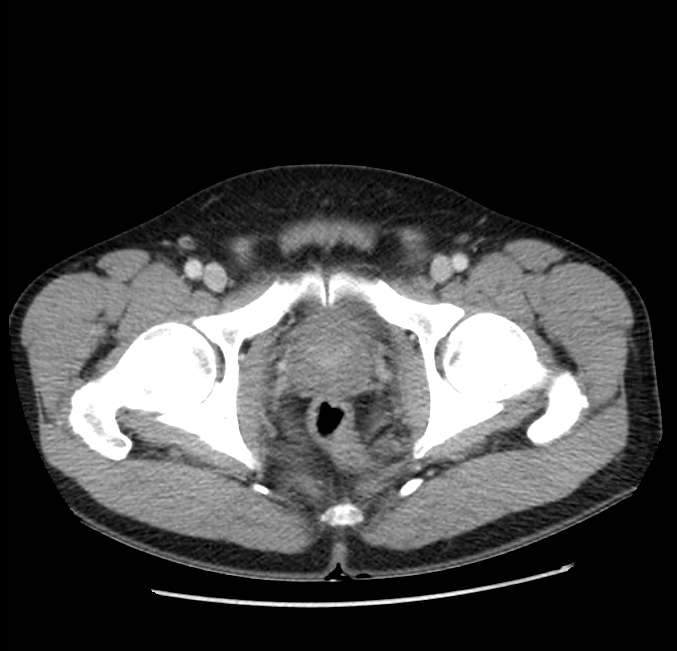 Acute pancreatitis - Balthazar E (Radiopaedia 23080-23110 Axial C+ portal venous phase 71).jpg