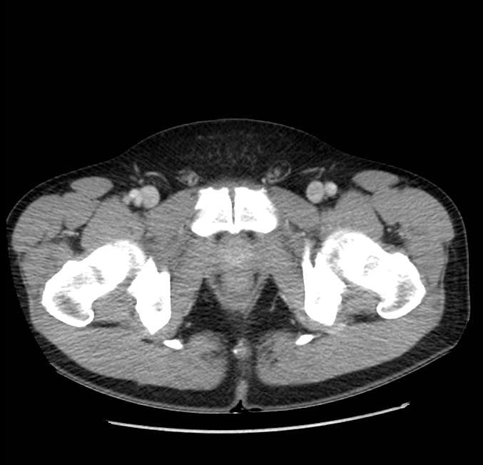 Acute pancreatitis - Balthazar E (Radiopaedia 23080-23110 Axial C+ portal venous phase 74).jpg