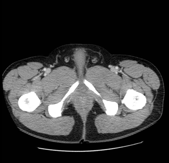 Acute pancreatitis - Balthazar E (Radiopaedia 23080-23110 Axial C+ portal venous phase 79).jpg