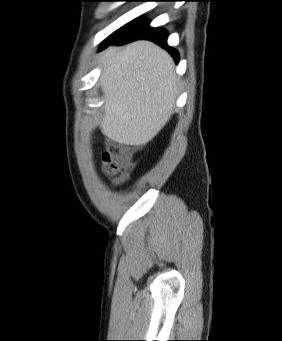 Acute pancreatitis - Balthazar E (Radiopaedia 23080-23110 Sagittal C+ portal venous phase 7).jpg