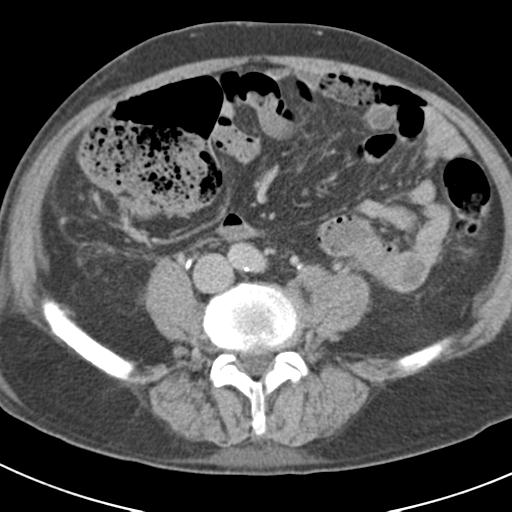 Acute pancreatitis and walled-off necrosis (Radiopaedia 29888-30403 Axial C+ delayed 53).jpg