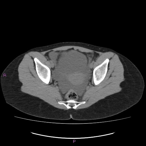 File:Acute pancreatitis secondary to stone at minor papilla and pancreatic divisum (Radiopaedia 76570-88333 Axial non-contrast 68).jpg
