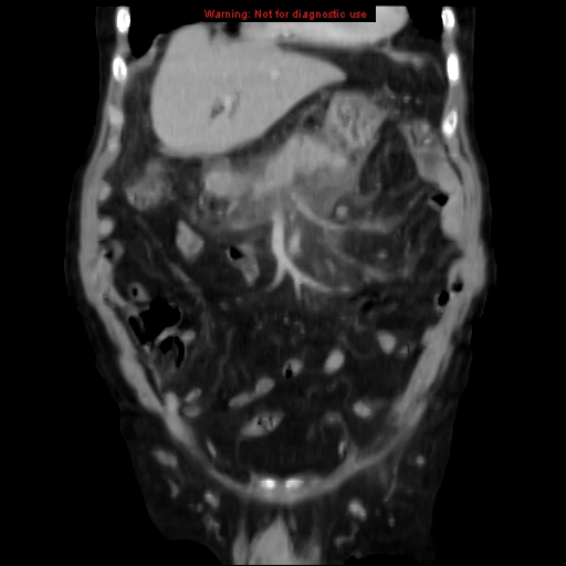Acute pancreatitis with incidental pancreatic lipoma (Radiopaedia 10190-10730 Coronal C+ portal venous phase 21).jpg