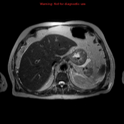 File:Acute pancreatitis with incidental pancreatic lipoma (Radiopaedia 10190-10732 Axial T2 19).jpg