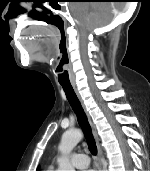 File:Acute parotitis (Radiopaedia 27425-27619 Sagittal C+ portal venous phase 29).png