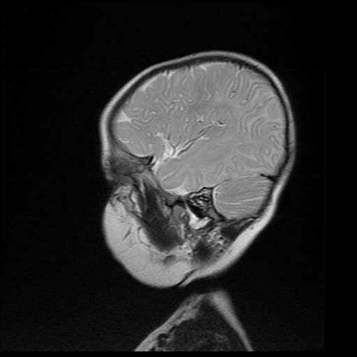 File:Acute phase of hemiconvulsion-hemiplegia epilepsy syndrome (Radiopaedia 29309-29745 Sagittal T2 17).jpg