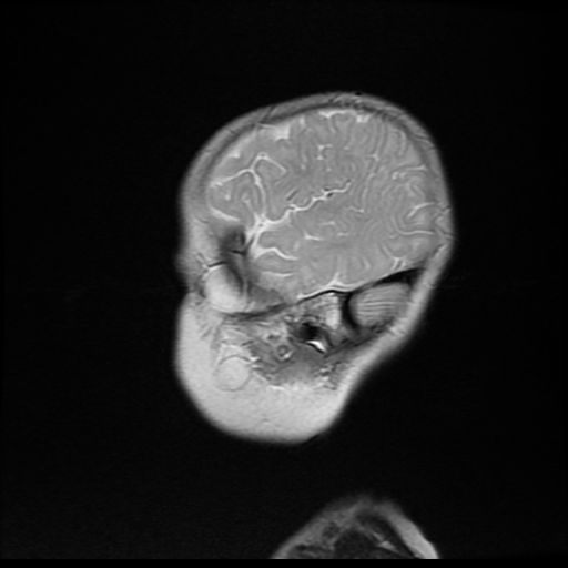 File:Acute phase of hemiconvulsion-hemiplegia epilepsy syndrome (Radiopaedia 29309-29745 Sagittal T2 4).jpg
