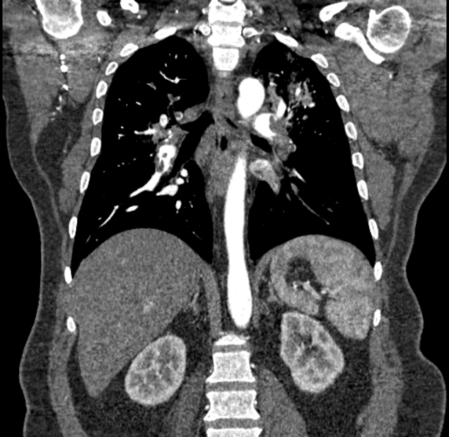 Acute pulmonary embolism with pulmonary infarcts (Radiopaedia 77688-89908 Coronal C+ CTPA 61).jpg