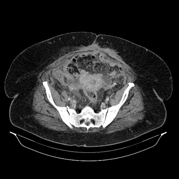 Acute pyelonephritis (Radiopaedia 25657-25837 Axial renal parenchymal phase 63).jpg