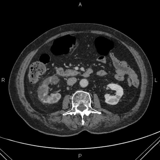 File:Acute renal artery occlusion (Radiopaedia 86586-102682 Axial C+ portal venous phase 37).jpg