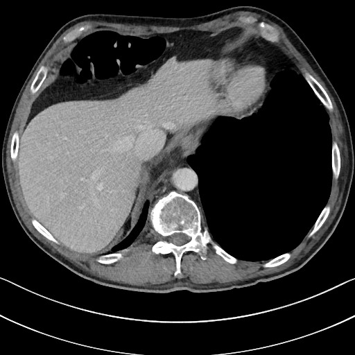 Acute renal infarction - rim capsular enhancement (Radiopaedia 59833-67270 Axial C+ portal venous phase 15).jpg